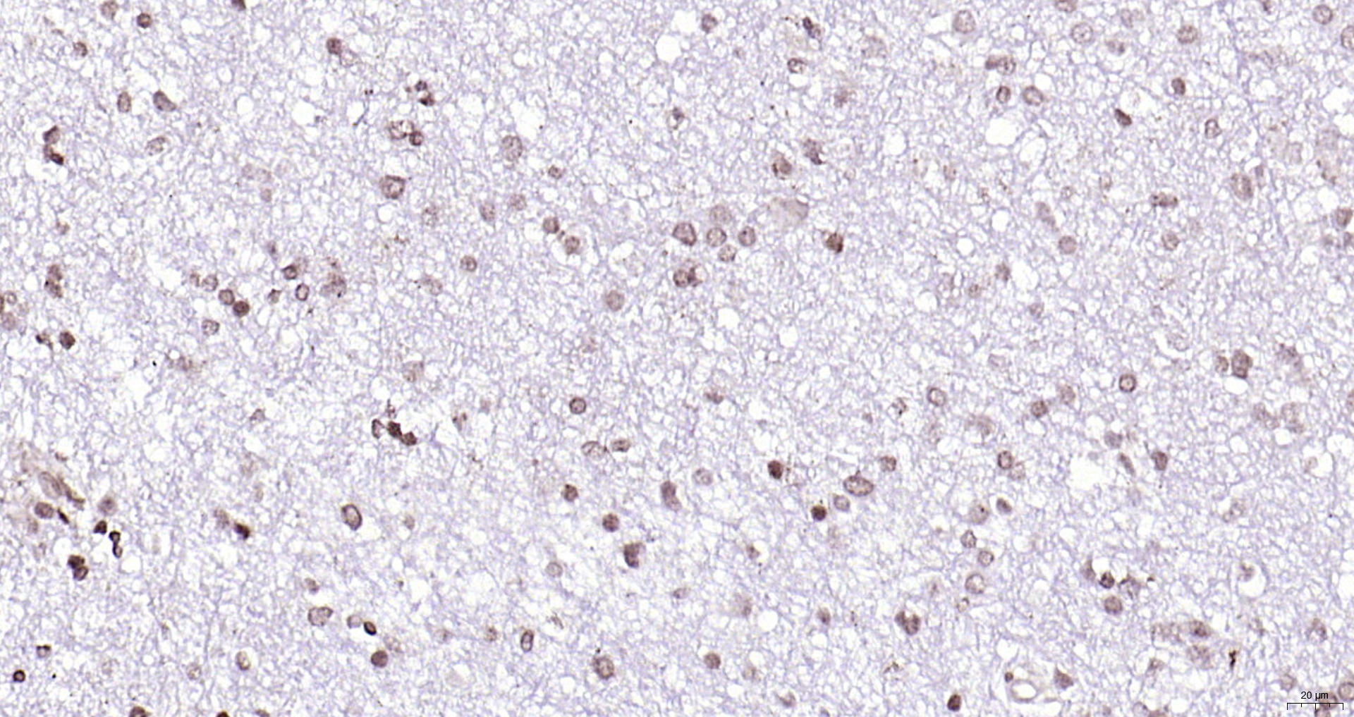 Paraformaldehyde-fixed, paraffin embedded (human brain glioma); Antigen retrieval by boiling in sodium citrate buffer (pH6.0) for 15min; Block endogenous peroxidase by 3% hydrogen peroxide for 20 minutes; Blocking buffer (normal goat serum) at 37°C for 30min; Antibody incubation with (SOX4) Polyclonal Antibody, Unconjugated (bs-11208R) at 1:200 overnight at 4°C, followed by operating according to SP Kit(Rabbit) (sp-0023) instructionsand DAB staining.