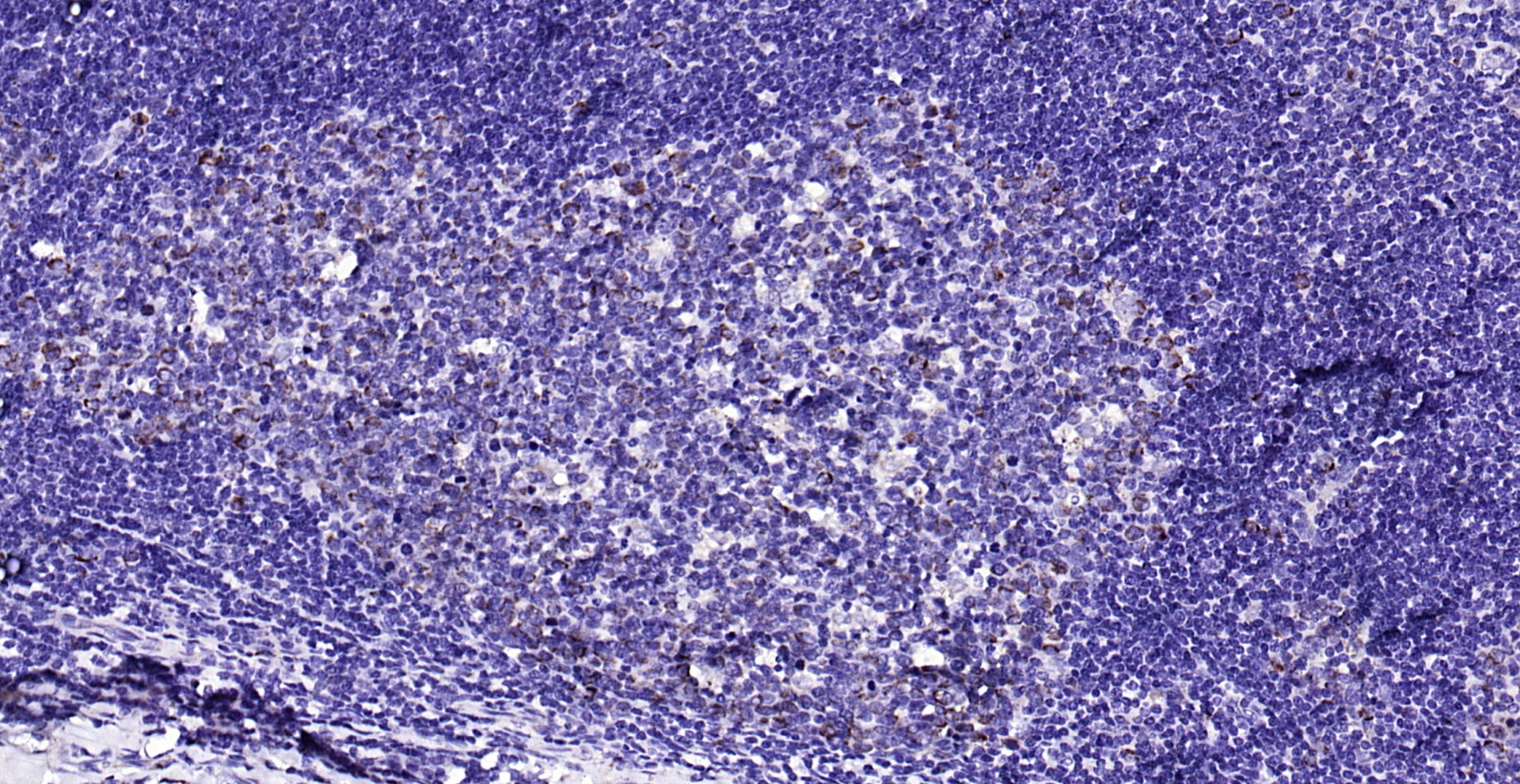 Paraformaldehyde-fixed, paraffin embedded (human tonsil); Antigen retrieval by boiling in sodium citrate buffer (pH6.0) for 15min; Block endogenous peroxidase by 3% hydrogen peroxide for 20 minutes; Blocking buffer (normal goat serum) at 37°C for 30min; Antibody incubation with (ECM1) Polyclonal Antibody, Unconjugated (bs-0776R) at 1:200 overnight at 4°C, followed by operating according to SP Kit(Rabbit) (sp-0023) instructionsand DAB staining.