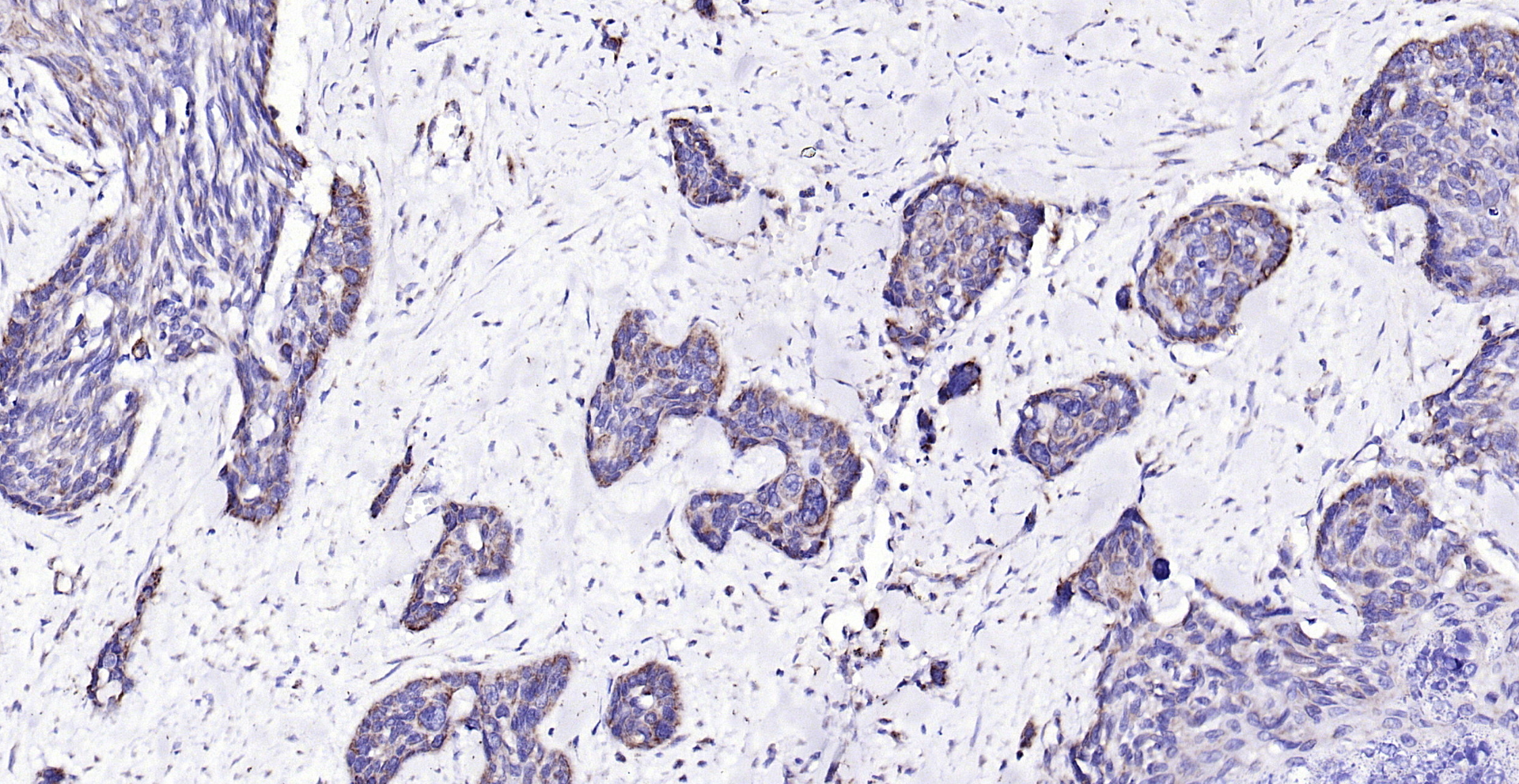 Paraformaldehyde-fixed, paraffin embedded (human esophageal); Antigen retrieval by boiling in sodium citrate buffer (pH6.0) for 15min; Block endogenous peroxidase by 3% hydrogen peroxide for 20 minutes; Blocking buffer (normal goat serum) at 37°C for 30min; Antibody incubation with (ECM1) Polyclonal Antibody, Unconjugated (bs-0776R) at 1:200 overnight at 4°C, followed by operating according to SP Kit(Rabbit) (sp-0023) instructionsand DAB staining.