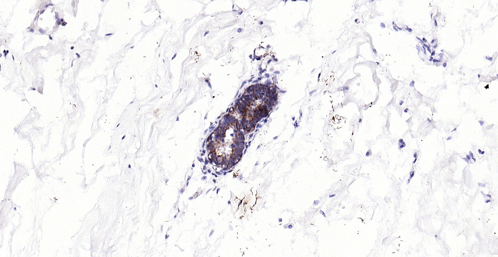 Paraformaldehyde-fixed, paraffin embedded (human breast carcinoma); Antigen retrieval by boiling in sodium citrate buffer (pH6.0) for 15min; Block endogenous peroxidase by 3% hydrogen peroxide for 20 minutes; Blocking buffer (normal goat serum) at 37°C for 30min; Antibody incubation with (ECM1) Polyclonal Antibody, Unconjugated (bs-0776R) at 1:200 overnight at 4°C, followed by operating according to SP Kit(Rabbit) (sp-0023) instructionsand DAB staining.