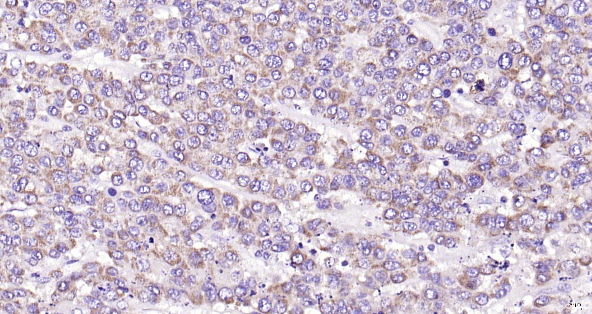 Paraformaldehyde-fixed, paraffin embedded (human liver carcinoma); Antigen retrieval by boiling in sodium citrate buffer (pH6.0) for 15min; Block endogenous peroxidase by 3% hydrogen peroxide for 20 minutes; Blocking buffer (normal goat serum) at 37°C for 30min; Antibody incubation with (IFN-Beta) Polyclonal Antibody, Unconjugated (bs-0787R) at 1:200 overnight at 4°C, followed by operating according to SP Kit(Rabbit) (sp-0023) instructionsand DAB staining.