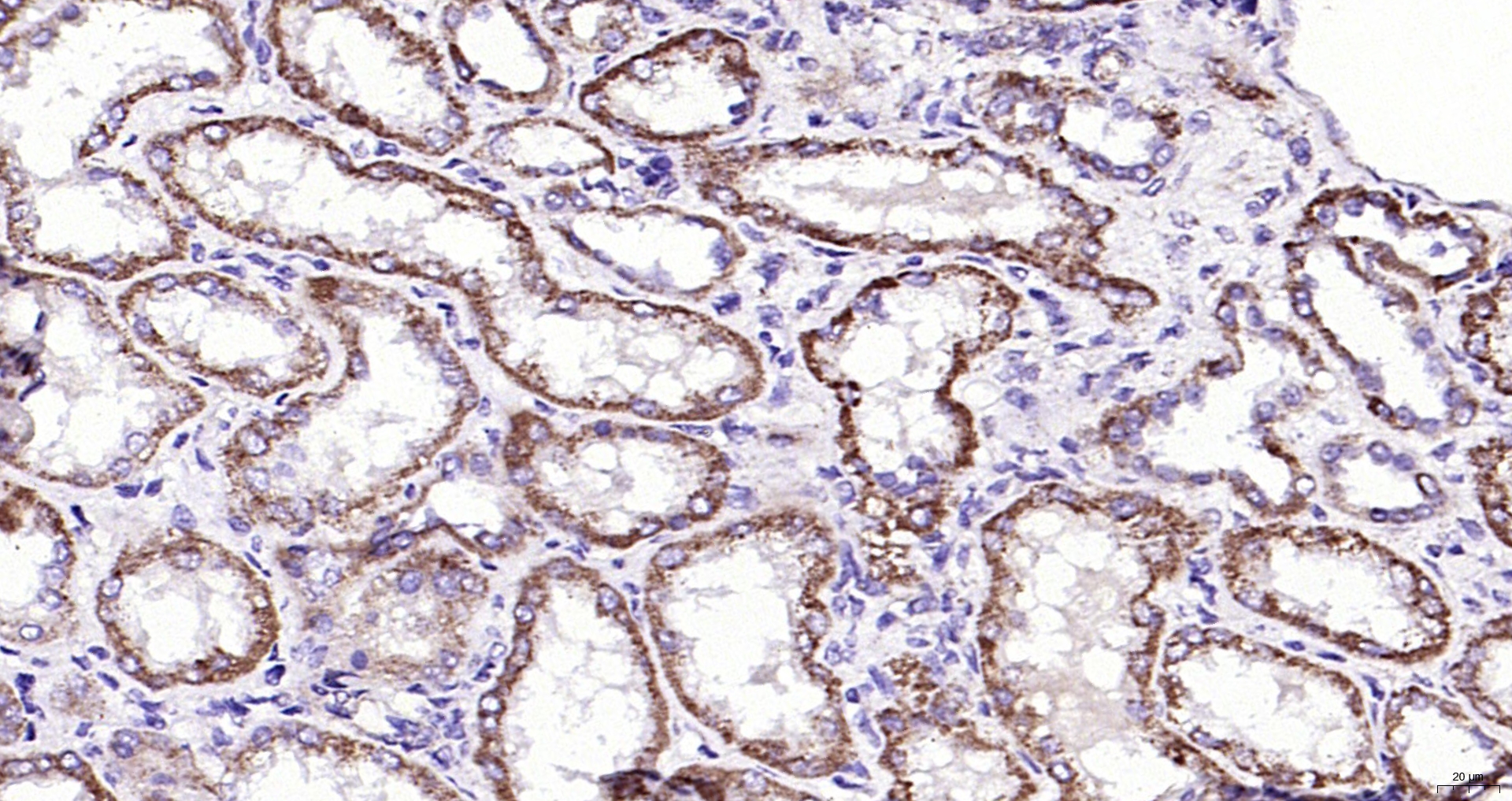 Paraformaldehyde-fixed, paraffin embedded (human kidney carcinoma); Antigen retrieval by boiling in sodium citrate buffer (pH6.0) for 15min; Block endogenous peroxidase by 3% hydrogen peroxide for 20 minutes; Blocking buffer (normal goat serum) at 37°C for 30min; Antibody incubation with (IFN-Beta) Polyclonal Antibody, Unconjugated (bs-0787R) at 1:200 overnight at 4°C, followed by operating according to SP Kit(Rabbit) (sp-0023) instructionsand DAB staining.