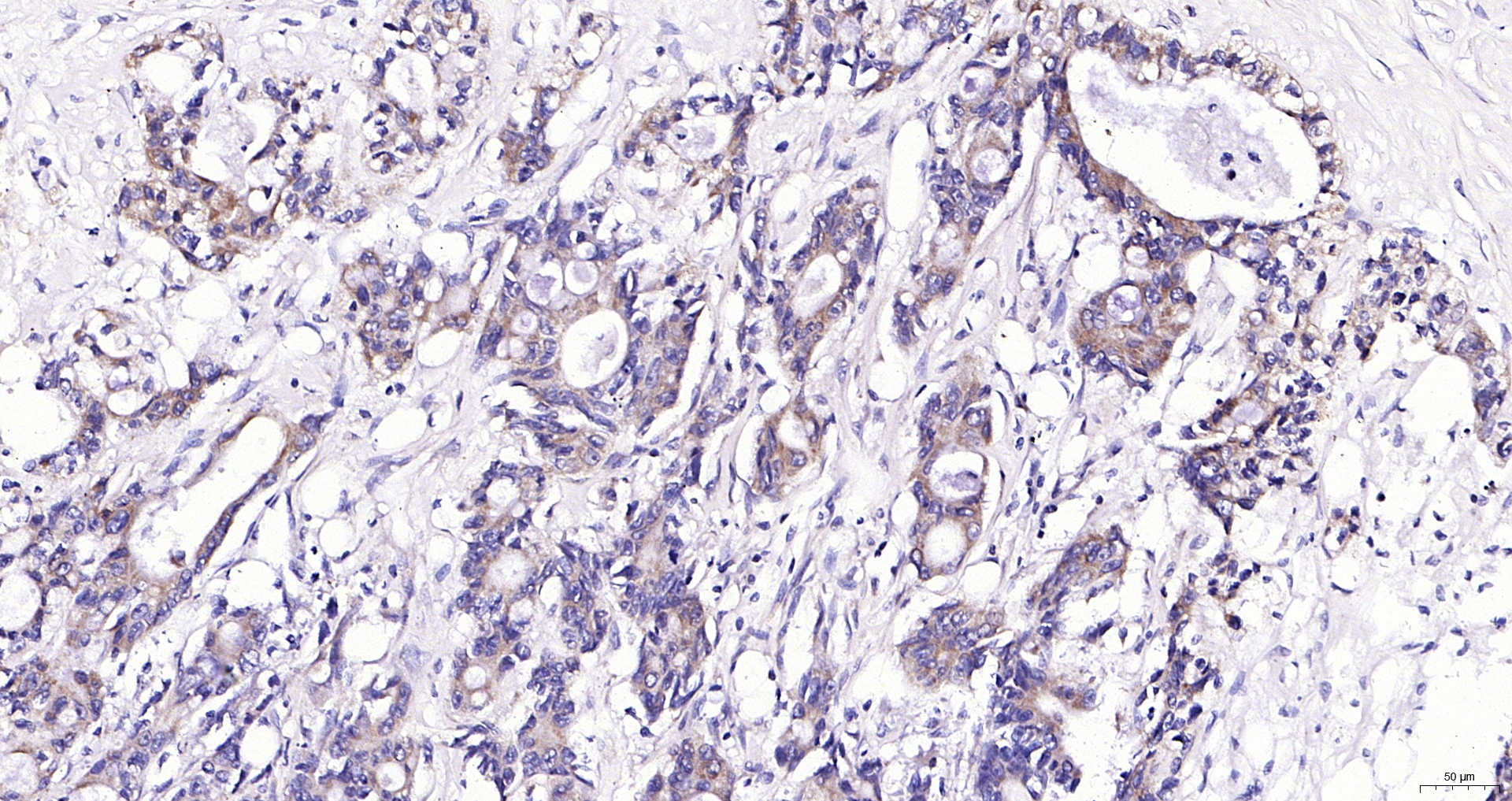 Paraformaldehyde-fixed, paraffin embedded (human rectal carcinoma); Antigen retrieval by boiling in sodium citrate buffer (pH6.0) for 15min; Block endogenous peroxidase by 3% hydrogen peroxide for 20 minutes; Blocking buffer (normal goat serum) at 37°C for 30min; Antibody incubation with (CRIPTO) Polyclonal Antibody, Unconjugated (bs-1566R) at 1:200 overnight at 4°C, followed by operating according to SP Kit(Rabbit) (sp-0023) instructionsand DAB staining.
