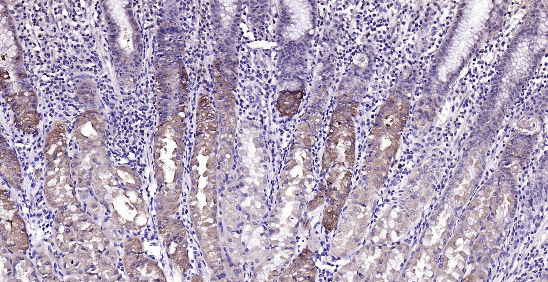 Paraformaldehyde-fixed, paraffin embedded (Human stomach); Antigen retrieval by boiling in sodium citrate buffer (pH6.0) for 15min; Block endogenous peroxidase by 3% hydrogen peroxide for 20 minutes; Blocking buffer (normal goat serum) at 37°C for 30min; Antibody incubation with (phospho-MST4 + MST3 + STK25 (Thr178 + Thr190 + Thr174) ) Polyclonal Antibody, Unconjugated (bs-10441R) at 1:200 overnight at 4°C, followed by operating according to SP Kit(Rabbit) (sp-0023) instructionsand DAB staining.