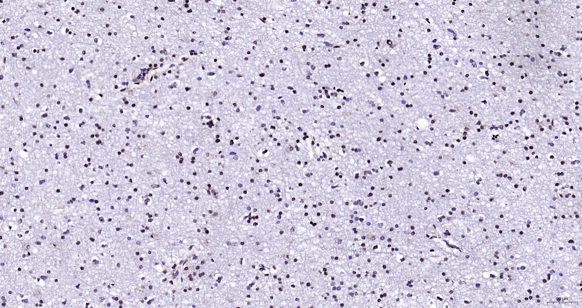 Paraformaldehyde-fixed, paraffin embedded (human brain glioma); Antigen retrieval by boiling in sodium citrate buffer (pH6.0) for 15min; Block endogenous peroxidase by 3% hydrogen peroxide for 20 minutes; Blocking buffer (normal goat serum) at 37°C for 30min; Antibody incubation with (Neuro D) Polyclonal Antibody, Unconjugated (bs-11573R) at 1:200 overnight at 4°C, followed by operating according to SP Kit(Rabbit) (sp-0023) instructionsand DAB staining.