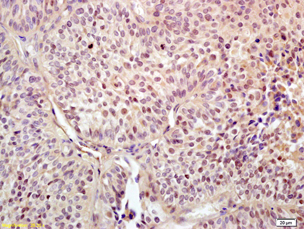 Formalin-fixed and paraffin embedded human endometrial carcinoma labeled with Anti-UBF1/RNA polymerase I Polyclonal Antibody, Unconjugated (bs-2362R) at 1:200 followed by conjugation to the secondary antibody and DAB staining