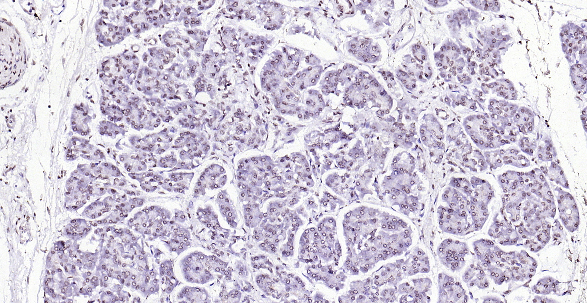 Paraformaldehyde-fixed, paraffin embedded (human pancreatic cancer); Antigen retrieval by boiling in sodium citrate buffer (pH6.0) for 15min; Block endogenous peroxidase by 3% hydrogen peroxide for 20 minutes; Blocking buffer (normal goat serum) at 37°C for 30min; Antibody incubation with (VEGFR3) Polyclonal Antibody, Unconjugated (bs-1083R) at 1:200 overnight at 4°C, followed by operating according to SP Kit(Rabbit) (sp-0023) instructionsand DAB staining.
