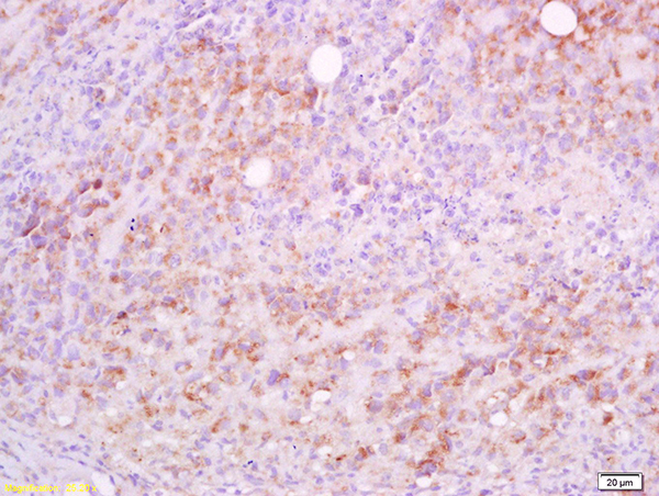 Formalin-fixed and paraffin embedded mouse lymphoma tissue labeled with Anti-CD5L/Api6 Polyclonal Antibody, Unconjugated(bs-2487R) at 1:200 followed by conjugation to the secondary antibody and DAB staining Formalin-fixed and paraffin embedded mouse lymphoma tissue labeled with Anti-CD5L/Api6 Polyclonal Antibody, Unconjugated(bs-2487R) at 1:200 followed by conjugation to the secondary antibody and DAB staining