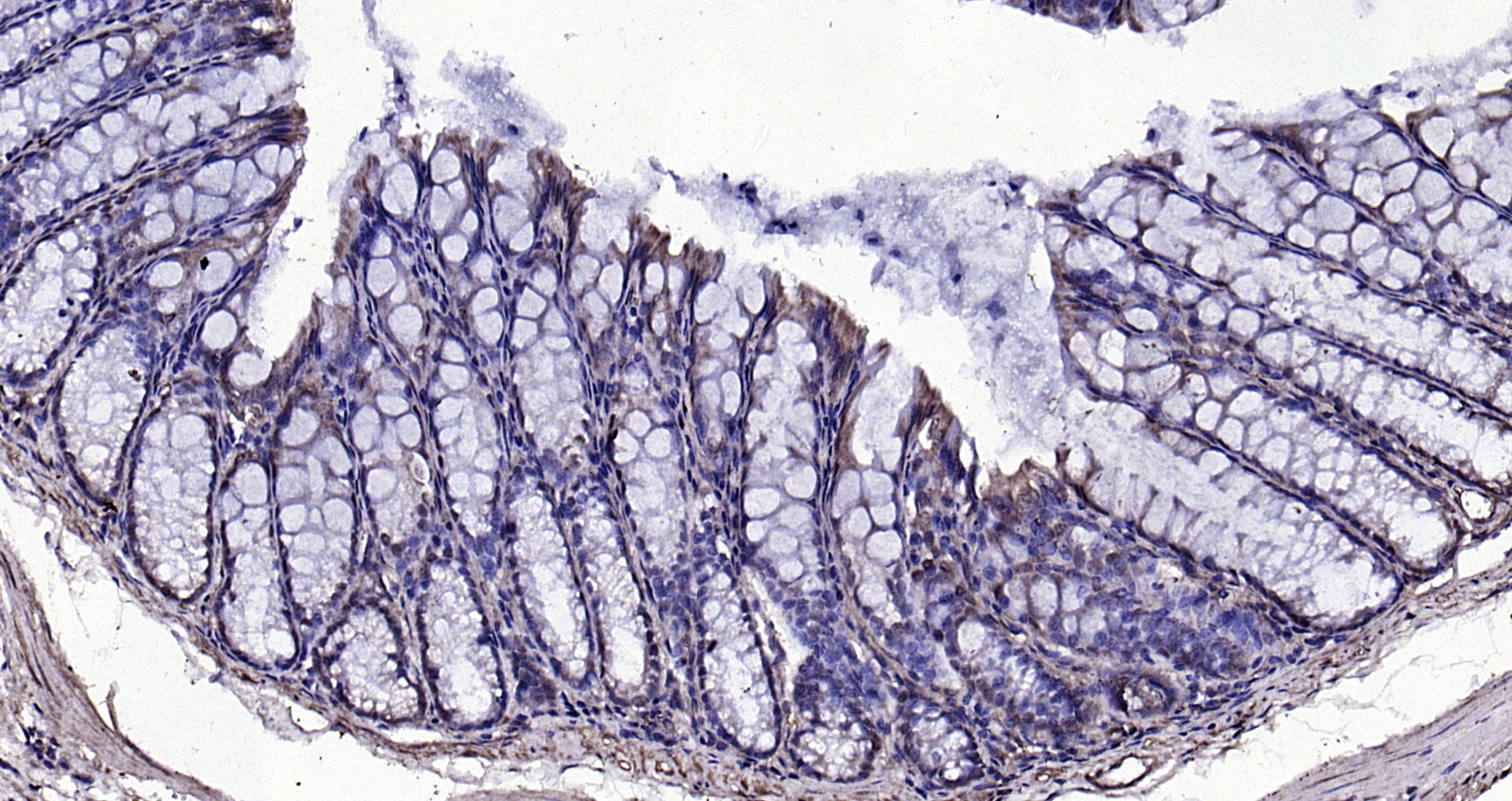 Paraformaldehyde-fixed, paraffin embedded (mouse colon); Antigen retrieval by boiling in sodium citrate buffer (pH6.0) for 15min; Block endogenous peroxidase by 3% hydrogen peroxide for 20 minutes; Blocking buffer (normal goat serum) at 37°C for 30min; Antibody incubation with (CKIP-1 ) Polyclonal Antibody, Unconjugated (bs-1330R) at 1:200 overnight at 4°C, followed by operating according to SP Kit(Rabbit) (sp-0023) instructionsand DAB staining. Paraformaldehyde-fixed, paraffin embedded (mouse colon); Antigen retrieval by boiling in sodium citrate buffer (pH6.0) for 15min; Block endogenous peroxidase by 3% hydrogen peroxide for 20 minutes; Blocking buffer (normal goat serum) at 37°C for 30min; Antibody incubation with (CKIP-1 ) Polyclonal Antibody, Unconjugated (bs-1330R) at 1:200 overnight at 4°C, followed by operating according to SP Kit(Rabbit) (sp-0023) instructionsand DAB staining.