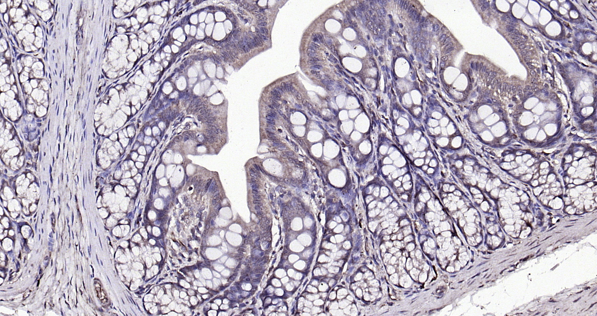 Paraformaldehyde-fixed, paraffin embedded (rat colon); Antigen retrieval by boiling in sodium citrate buffer (pH6.0) for 15min; Block endogenous peroxidase by 3% hydrogen peroxide for 20 minutes; Blocking buffer (normal goat serum) at 37°C for 30min; Antibody incubation with (CKIP-1 ) Polyclonal Antibody, Unconjugated (bs-1330R) at 1:200 overnight at 4°C, followed by operating according to SP Kit(Rabbit) (sp-0023) instructionsand DAB staining. Paraformaldehyde-fixed, paraffin embedded (rat colon); Antigen retrieval by boiling in sodium citrate buffer (pH6.0) for 15min; Block endogenous peroxidase by 3% hydrogen peroxide for 20 minutes; Blocking buffer (normal goat serum) at 37°C for 30min; Antibody incubation with (CKIP-1 ) Polyclonal Antibody, Unconjugated (bs-1330R) at 1:200 overnight at 4°C, followed by operating according to SP Kit(Rabbit) (sp-0023) instructionsand DAB staining.