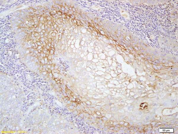 Formalin-fixed and paraffin embedded human laryngeal cancer labeled with Anti-MCSF ReceptorPolyclonal Antibody, Unconjugated(bs-2755R) at 1:200 followed by conjugation to the secondary antibody and DAB staining