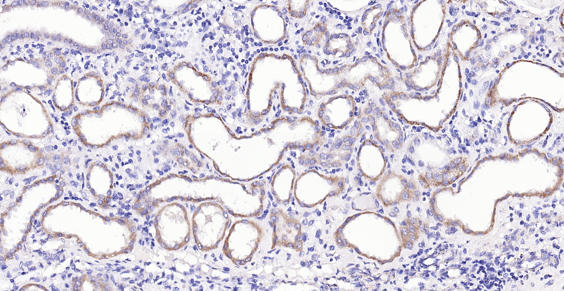 Paraformaldehyde-fixed, paraffin embedded (human kidney carcinoma); Antigen retrieval by boiling in sodium citrate buffer (pH6.0) for 15min; Block endogenous peroxidase by 3% hydrogen peroxide for 20 minutes; Blocking buffer (normal goat serum) at 37°C for 30min; Antibody incubation with (Aquaporin 4) Polyclonal Antibody, Unconjugated (bs-0634R) at 1:200 overnight at 4°C, followed by operating according to SP Kit(Rabbit) (sp-0023) instructionsand DAB staining.