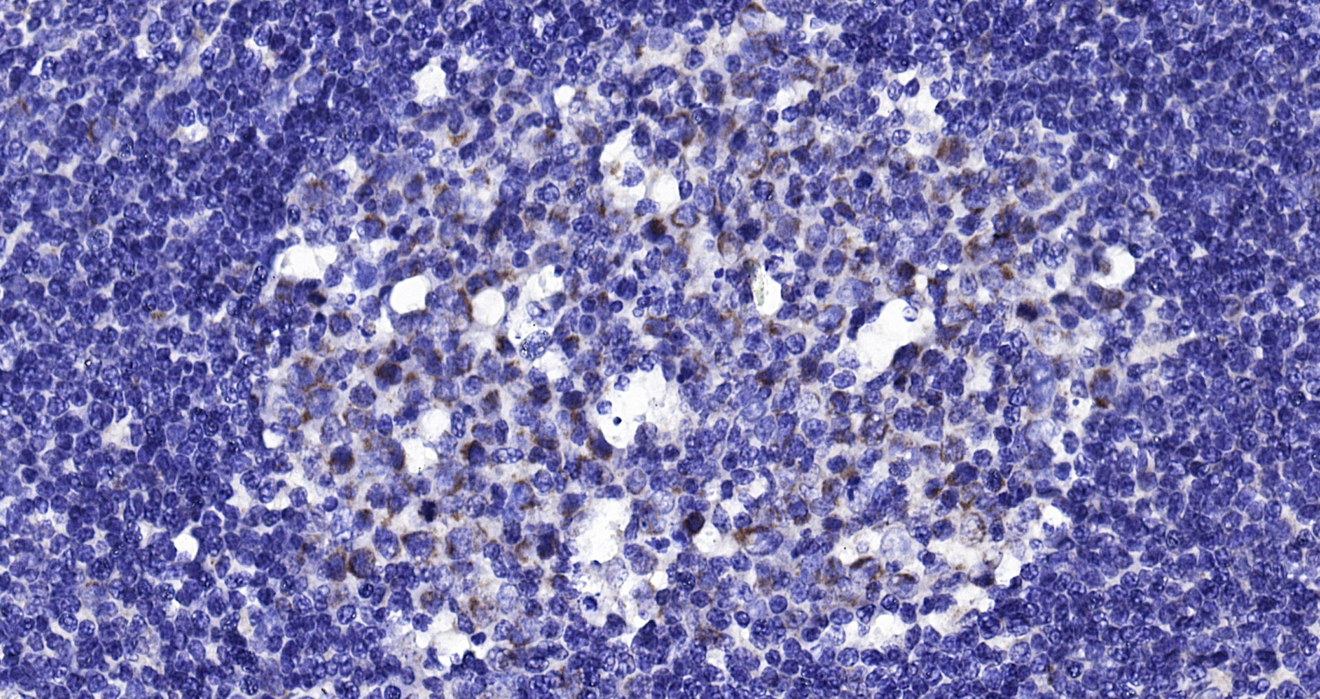 Paraformaldehyde-fixed, paraffin embedded (human tonsil); Antigen retrieval by boiling in sodium citrate buffer (pH6.0) for 15min; Block endogenous peroxidase by 3% hydrogen peroxide for 20 minutes; Blocking buffer (normal goat serum) at 37°C for 30min; Antibody incubation with (IL-1RA) Polyclonal Antibody, Unconjugated (bs-2216R) at 1:200 overnight at 4°C, followed by operating according to SP Kit(Rabbit) (sp-0023) instructionsand DAB staining.