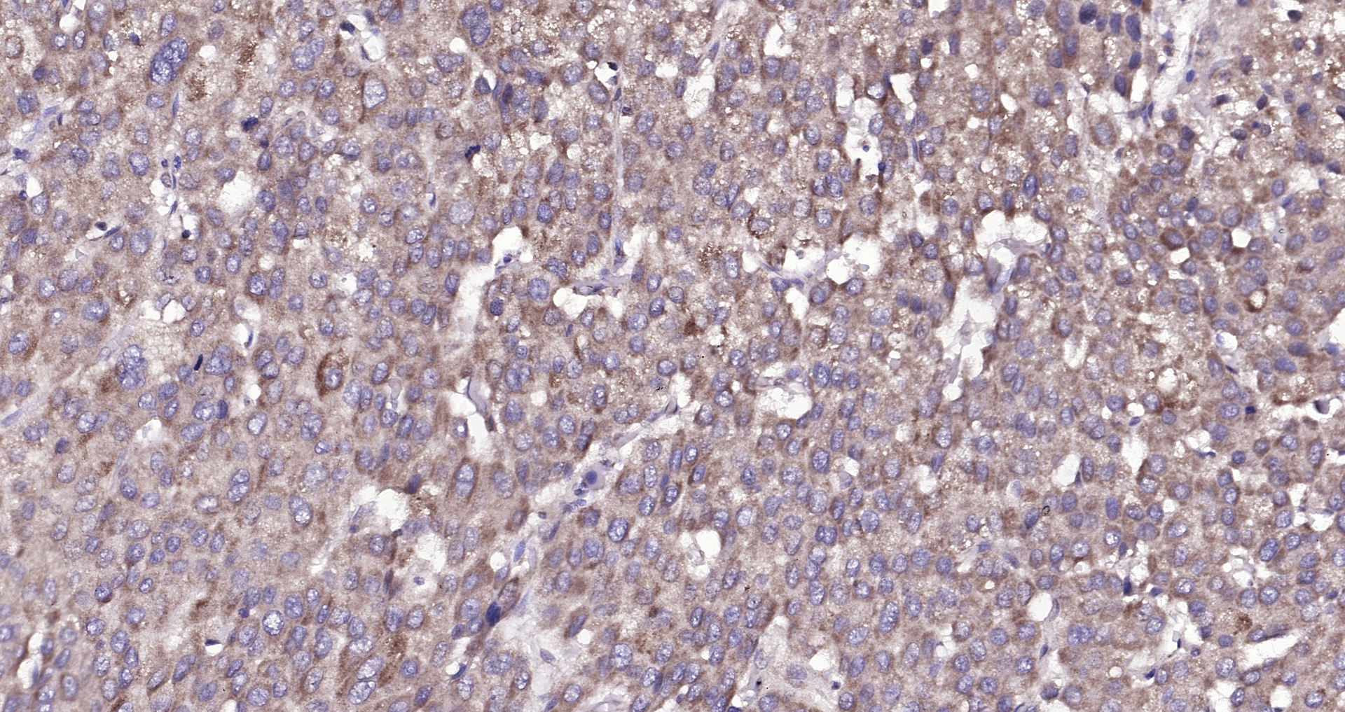 Paraformaldehyde-fixed, paraffin embedded (human liver carcinoma); Antigen retrieval by boiling in sodium citrate buffer (pH6.0) for 15min; Block endogenous peroxidase by 3% hydrogen peroxide for 20 minutes; Blocking buffer (normal goat serum) at 37°C for 30min; Antibody incubation with (Amphiregulin) Polyclonal Antibody, Unconjugated (bs-3847R) at 1:200 overnight at 4°C, followed by operating according to SP Kit(Rabbit) (sp-0023) instructions and DAB staining.