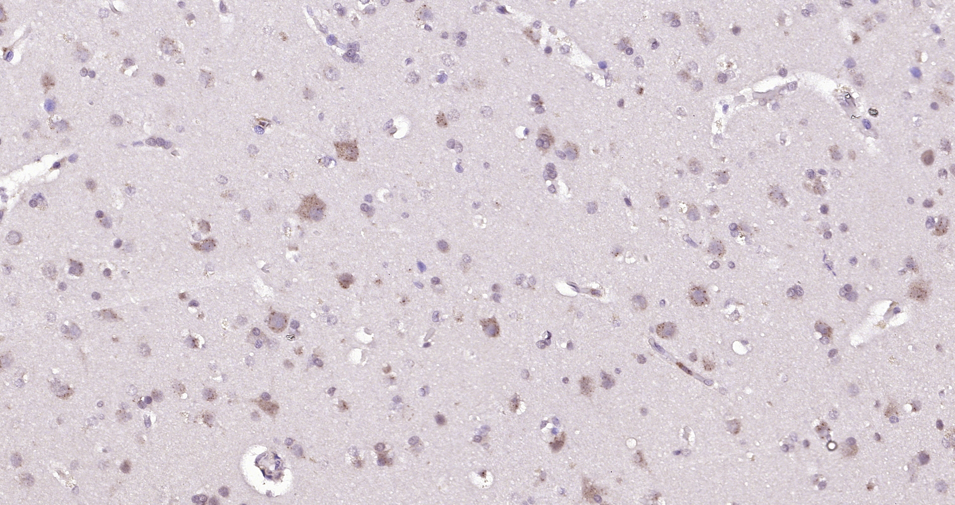 Paraformaldehyde-fixed, paraffin embedded (human brain glioma); Antigen retrieval by boiling in sodium citrate buffer (pH6.0) for 15min; Block endogenous peroxidase by 3% hydrogen peroxide for 20 minutes; Blocking buffer (normal goat serum) at 37°C for 30min; Antibody incubation with (B4GALNT1) Polyclonal Antibody, Unconjugated (bs-12706R) at 1:200 overnight at 4°C, followed by operating according to SP Kit(Rabbit) (sp-0023) instructionsand DAB staining.