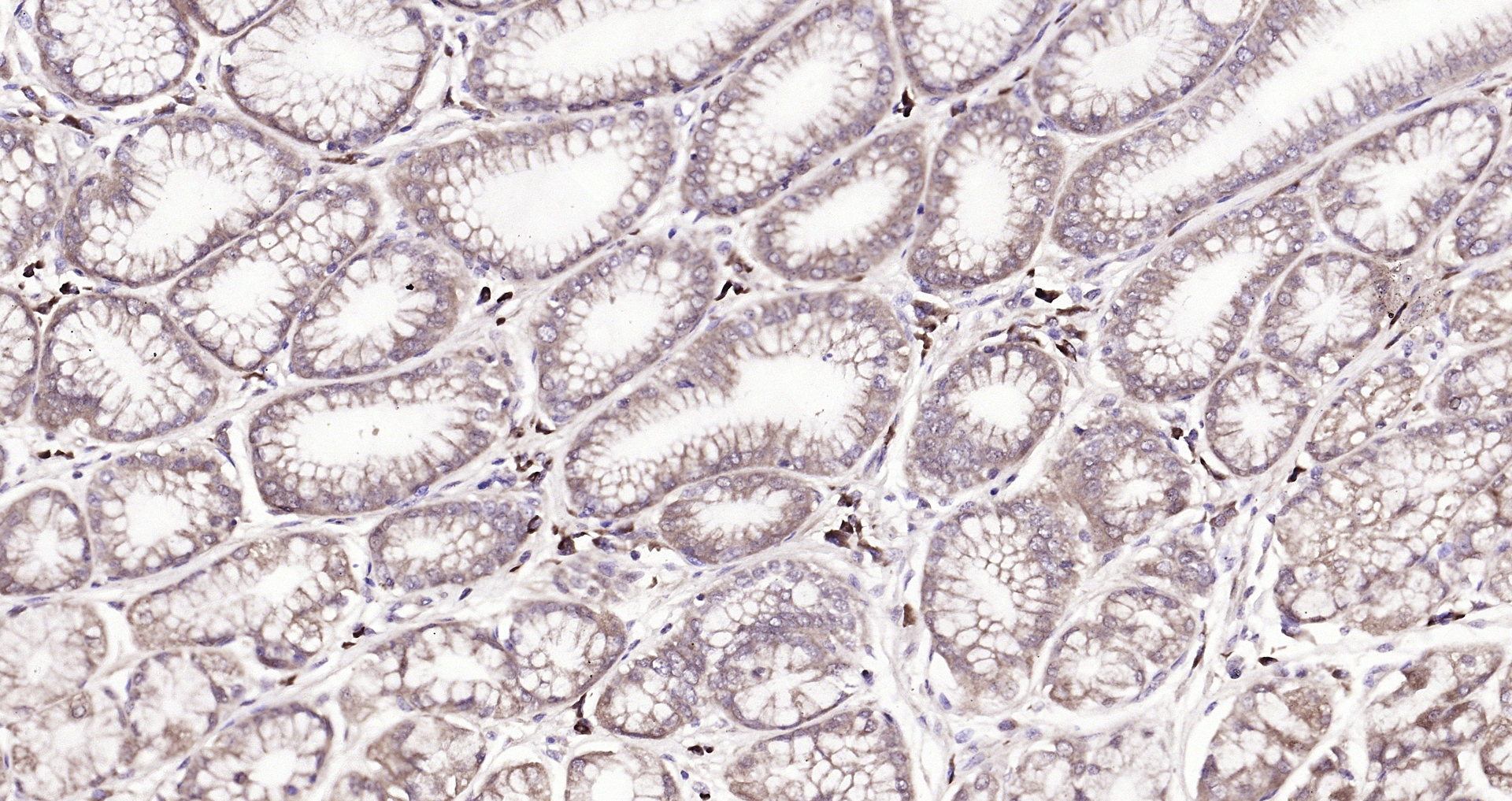 Paraformaldehyde-fixed, paraffin embedded (human gastric carcinoma); Antigen retrieval by boiling in sodium citrate buffer (pH6.0) for 15min; Block endogenous peroxidase by 3% hydrogen peroxide for 20 minutes; Blocking buffer (normal goat serum) at 37°C for 30min; Antibody incubation with (FBXO2) Polyclonal Antibody, Unconjugated (bs-13149R) at 1:200 overnight at 4°C, followed by operating according to SP Kit(Rabbit) (sp-0023) instructionsand DAB staining. Paraformaldehyde-fixed, paraffin embedded (human gastric carcinoma); Antigen retrieval by boiling in sodium citrate buffer (pH6.0) for 15min; Block endogenous peroxidase by 3% hydrogen peroxide for 20 minutes; Blocking buffer (normal goat serum) at 37°C for 30min; Antibody incubation with (FBXO2) Polyclonal Antibody, Unconjugated (bs-13149R) at 1:200 overnight at 4°C, followed by operating according to SP Kit(Rabbit) (sp-0023) instructionsand DAB staining.