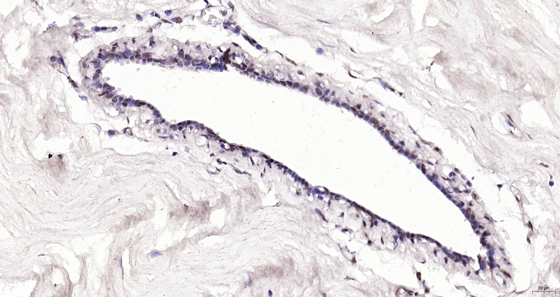 Paraformaldehyde-fixed, paraffin embedded (human breast carcinoma); Antigen retrieval by boiling in sodium citrate buffer (pH6.0) for 15min; Block endogenous peroxidase by 3% hydrogen peroxide for 20 minutes; Blocking buffer (normal goat serum) at 37°C for 30min; Antibody incubation with (SMEK1) Polyclonal Antibody, Unconjugated (bs-12636R) at 1:200 overnight at 4°C, followed by operating according to SP Kit(Rabbit) (sp-0023) instructionsand DAB staining.