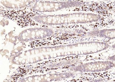 Paraformaldehyde-fixed, paraffin embedded (human colon carcinoma); Antigen retrieval by boiling in sodium citrate buffer (pH6.0) for 15min; Block endogenous peroxidase by 3% hydrogen peroxide for 20 minutes; Blocking buffer (normal goat serum) at 37°C for 30min; Antibody incubation with (AIF1) Polyclonal Antibody, Unconjugated (bs-1363R) at 1:200 overnight at 4°C, followed by operating according to SP Kit(Rabbit) (sp-0023) instructionsand DAB staining.