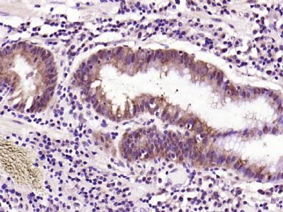 Paraformaldehyde-fixed, paraffin embedded (human gastric carcinoma); Antigen retrieval by boiling in sodium citrate buffer (pH6.0) for 15min; Block endogenous peroxidase by 3% hydrogen peroxide for 20 minutes; Blocking buffer (normal goat serum) at 37°C for 30min; Antibody incubation with (EGFR) Polyclonal Antibody, Unconjugated (bs-0165R) at 1:200 overnight at 4°C, followed by operating according to SP Kit(Rabbit) (sp-0023) instructionsand DAB staining.