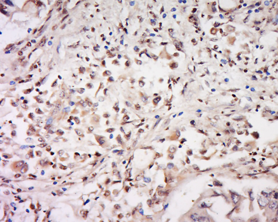 Tissue/cell: human lung carcinoma; 4% Paraformaldehyde-fixed and paraffin-embedded._x000D_ Antigen retrieval: citrate buffer ( 0.01M, pH 6.0 ), Boiling bathing for 15min; Block endogenous peroxidase by 3% Hydrogen peroxide for 30min; Blocking buffer (normal goat serum) at 37℃ for 20 min._x000D_ Incubation: Anti-CD93 Polyclonal Antibody, Unconjugated (bs-10232R) 1:200, overnight at 4°C, followed by conjugation to the secondary antibody and DAB staining.