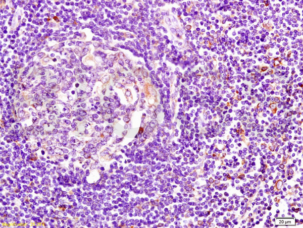 Formalin-fixed human pancreatic cancer tissue labeled with Anti-HLA DMβ Polyclonal Antibody, Unconjugated (bs-4298R) at 1:200 followed by conjugation to the secondary antibody and DAB staining