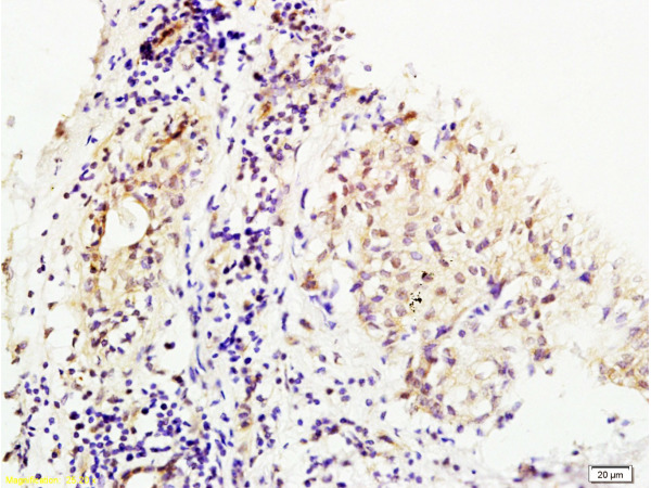 Formalin-fixed and human breast carcinoma tissue labeled with Anti-MMS19 Polyclonal Antibody, Unconjugated(bs-8671R) at 1:200 followed by conjugation to the secondary antibody and DAB staining