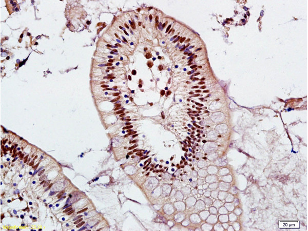 Formalin-fixed and adjacent noncancerous of human colon tissue labeled with Anti-Mel18/ZNF144 Polyclonal Antibody, Unconjugated (bs-9673R) at 1:200 followed by conjugation to the secondary antibody and DAB staining