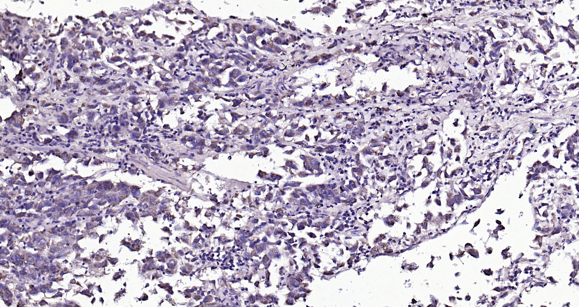 Paraformaldehyde-fixed, paraffin embedded (human lung carcinoma); Antigen retrieval by boiling in sodium citrate buffer (pH6.0) for 15min; Block endogenous peroxidase by 3% hydrogen peroxide for 20 minutes; Blocking buffer (normal goat serum) at 37°C for 30min; Antibody incubation with (Angiopoietin-1) Polyclonal Antibody, Unconjugated (bs-0800R) at 1:200 overnight at 4°C, followed by operating according to SP Kit(Rabbit) (sp-0023) instructionsand DAB staining.