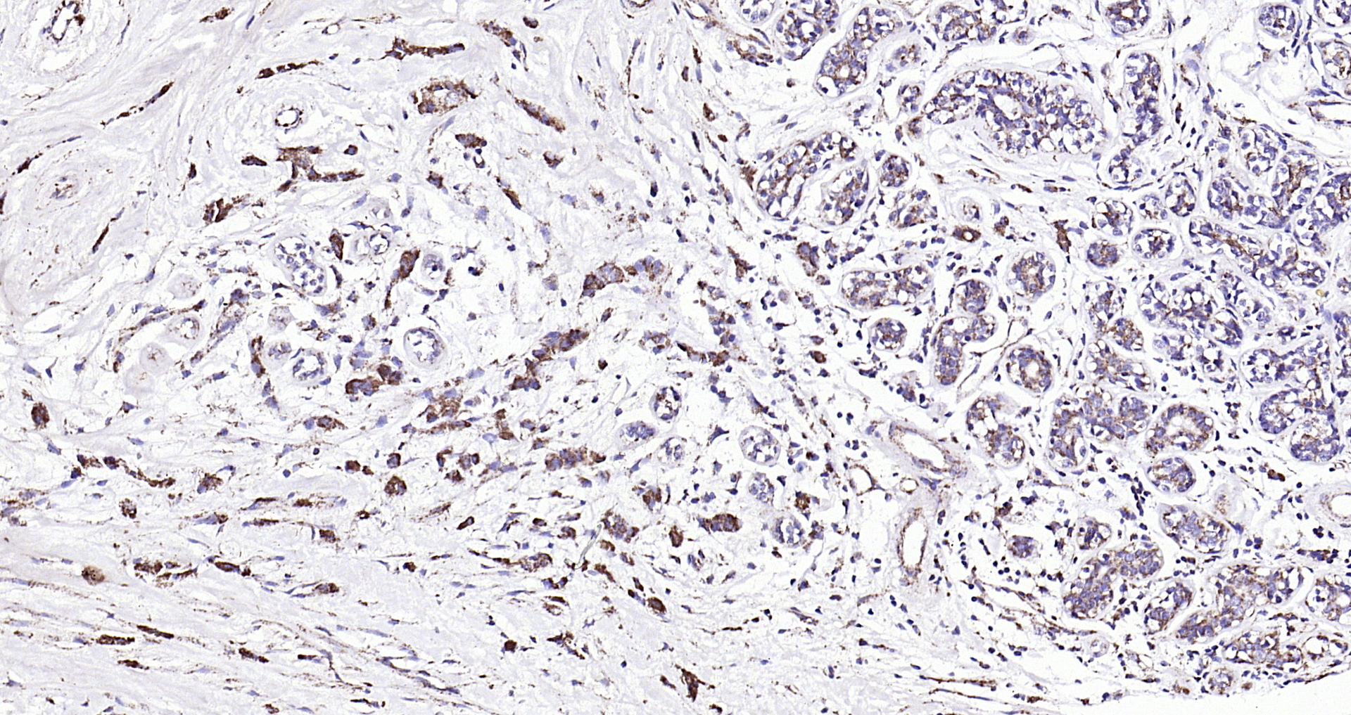 Paraformaldehyde-fixed, paraffin embedded (human colon carcinoma); Antigen retrieval by boiling in sodium citrate buffer (pH6.0) for 15min; Block endogenous peroxidase by 3% hydrogen peroxide for 20 minutes; Blocking buffer (normal goat serum) at 37°C for 30min; Antibody incubation with (Angiopoietin-1) Polyclonal Antibody, Unconjugated (bs-0800R) at 1:200 overnight at 4°C, followed by operating according to SP Kit(Rabbit) (sp-0023) instructionsand DAB staining.