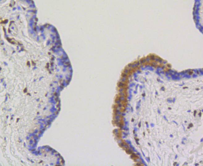Immunohistochemical analysis of paraffin-embedded human breast carcinoma tissue using anti-ATP citrate lyase antibody. The section was pre-treated using heat mediated antigen retrieval with Tris-EDTA buffer (pH 8.0-8.4) for 20 minutes.The tissues were blocked in 5% BSA for 30 minutes at room temperature, washed with ddH2O and PBS, and then probed with the primary antibody (bsm-52458R, 1/50) for 30 minutes at room temperature. The detection was performed using an HRP conjugated compact polymer system. DAB was used as the chromogen. Tissues were counterstained with hematoxylin and mounted with DPX.