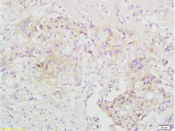 Formalin-fixed and paraffin embedded human gastric carcinoma tissue labeled with Anti-TRAF3\/CD40bp Polyclonal Antibody, Unconjugated (bs-1185R) at 1:200 followed by conjugation to the secondary antibody and DAB staining
