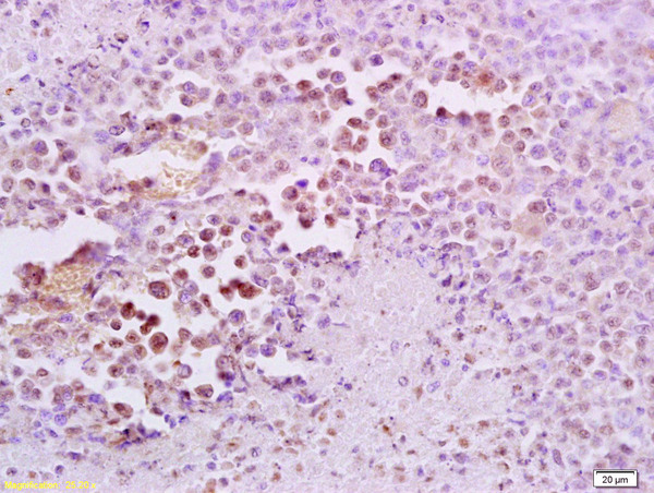 Formalin-fixed and paraffin embedded mouse lymphoma tissue labeled with Anti-FRA2/FOSL2 Polyclonal Antibody, Unconjugated (bs-1188R) at 1:200 followed by conjugation to the secondary antibody and DAB staining