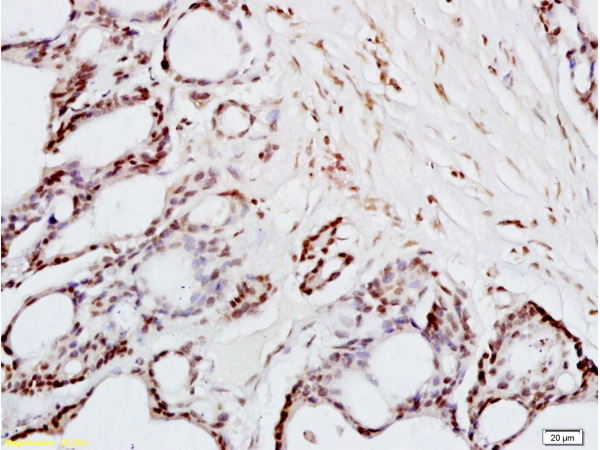 Formalin-fixed and paraffin embedded human colon carcinoma tissue labeled with Anti-FRA2/FOSL2 Polyclonal Antibody, Unconjugated (bs-1188R) at 1:200 followed by conjugation to the secondary antibody and DAB staining