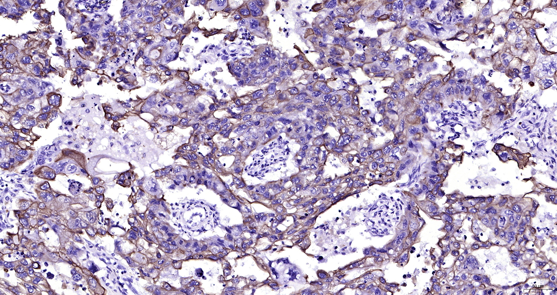 Paraformaldehyde-fixed, paraffin embedded (human skin cancer); Antigen retrieval by boiling in sodium citrate buffer (pH6.0) for 15min; Block endogenous peroxidase by 3% hydrogen peroxide for 20 minutes; Blocking buffer (normal goat serum) at 37°C for 30min; Antibody incubation with (CK16) Monoclonal Antibody, Unconjugated (ascites of bsm-33062M 8H6) at 1:2000 overnight at 4°C, followed by operating according to SP Kit(Mouse) (sp-0024) instructions and DAB staining.