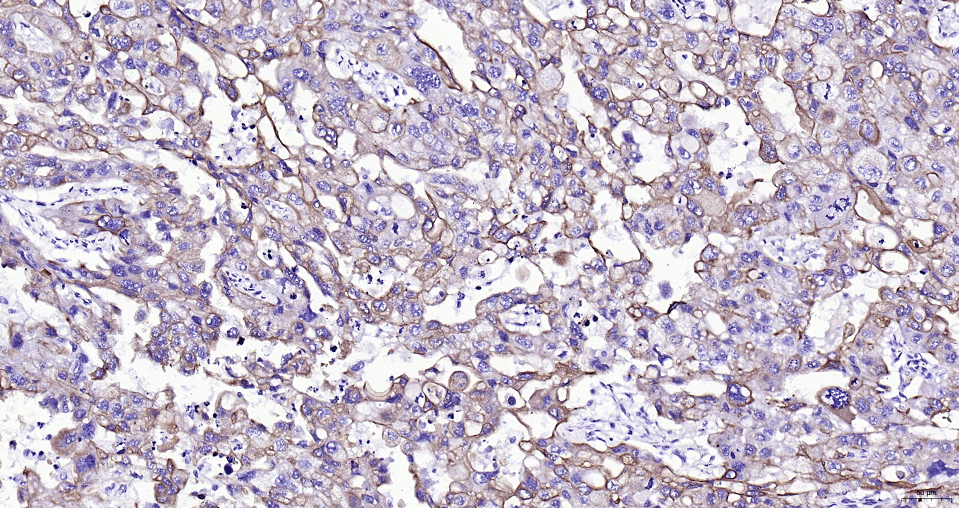 Paraformaldehyde-fixed, paraffin embedded (human skin cancer); Antigen retrieval by boiling in sodium citrate buffer (pH6.0) for 15min; Block endogenous peroxidase by 3% hydrogen peroxide for 20 minutes; Blocking buffer (normal goat serum) at 37°C for 30min; Antibody incubation with (CK16) Monoclonal Antibody, Unconjugated (ascites of bsm-33062M 8H6) at 1:2000 overnight at 4°C, followed by operating according to SP Kit(Mouse) (sp-0024) instructions and DAB staining.