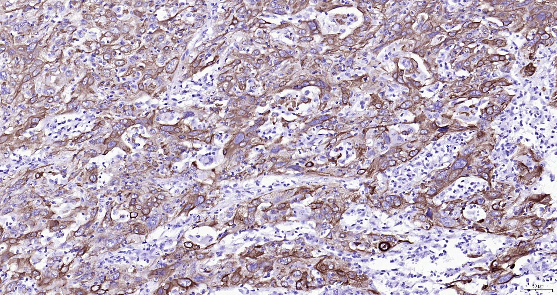 Paraformaldehyde-fixed, paraffin embedded (human cervical cancer); Antigen retrieval by boiling in sodium citrate buffer (pH6.0) for 15min; Block endogenous peroxidase by 3% hydrogen peroxide for 20 minutes; Blocking buffer (normal goat serum) at 37°C for 30min; Antibody incubation with (CK16) Monoclonal Antibody, Unconjugated (ascites of bsm-33062M 8H6) at 1:2000 overnight at 4°C, followed by operating according to SP Kit(Mouse) (sp-0024) instructions and DAB staining.