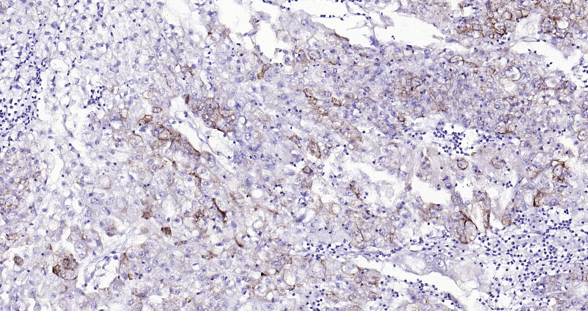 Paraformaldehyde-fixed, paraffin embedded (human endometrial carcinoma); Antigen retrieval by boiling in sodium citrate buffer (pH6.0) for 15min; Block endogenous peroxidase by 3% hydrogen peroxide for 20 minutes; Blocking buffer (normal goat serum) at 37°C for 30min; Antibody incubation with (CK7) Monoclonal Antibody, Unconjugated (bsm-33060M) at 1:200 overnight at 4°C, followed by operating according to SP Kit(Mouse)(sp-0024 bs-0296G-HRP 1:100) instructionsand DAB staining.