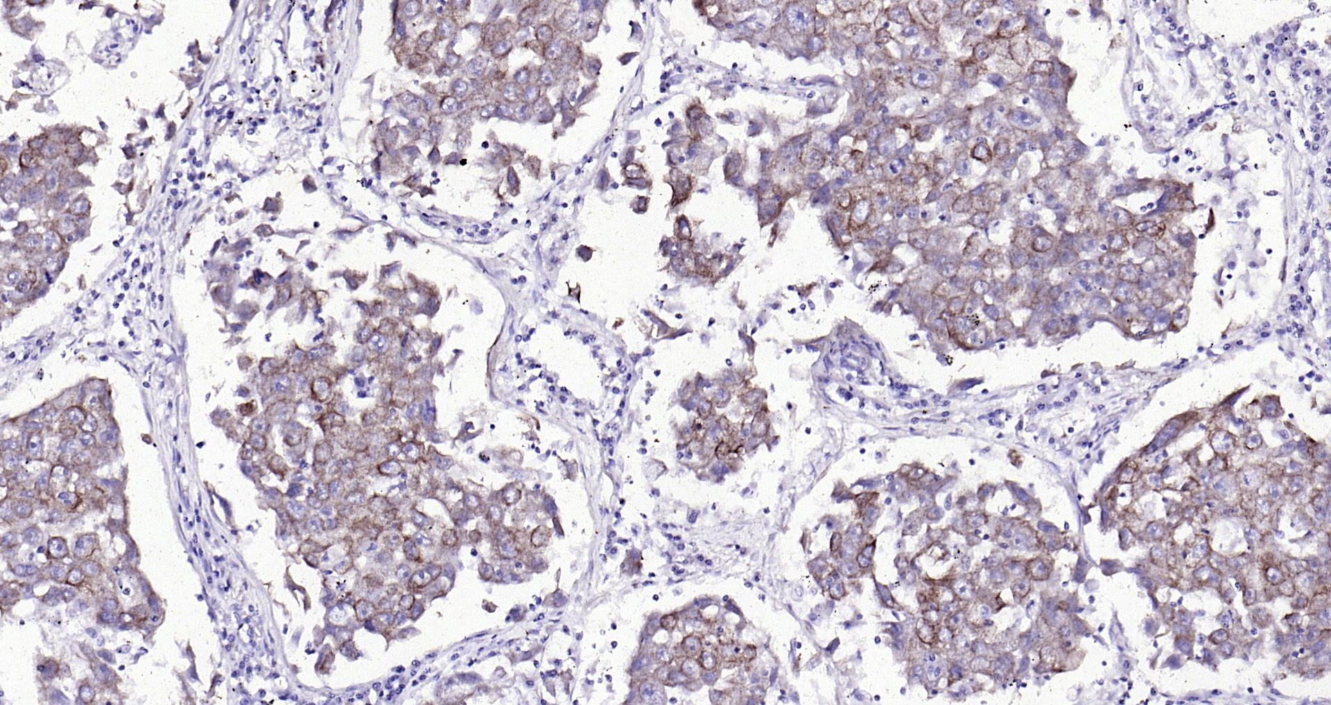 Paraformaldehyde-fixed, paraffin embedded (human lung carcinoma); Antigen retrieval by boiling in sodium citrate buffer (pH6.0) for 15min; Block endogenous peroxidase by 3% hydrogen peroxide for 20 minutes; Blocking buffer (normal goat serum) at 37°C for 30min; Antibody incubation with (Cytokeratin 8) Monoclonal Antibody, Unconjugated (bsm-33061M) at 1:200 overnight at 4°C, followed by operating according to SP Kit(Mouse)(sp-0024 bs-0296G-HRP 1:100) instructionsand DAB staining.