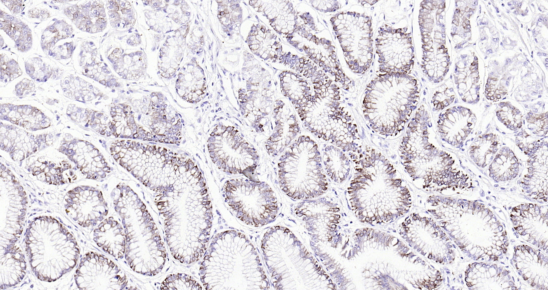 Paraformaldehyde-fixed, paraffin embedded (human gastric carcinoma); Antigen retrieval by boiling in sodium citrate buffer (pH6.0) for 15min; Block endogenous peroxidase by 3% hydrogen peroxide for 20 minutes; Blocking buffer (normal goat serum) at 37°C for 30min; Antibody incubation with (Cytokeratin 8) Monoclonal Antibody, Unconjugated (bsm-33061M) at 1:200 overnight at 4°C, followed by operating according to SP Kit(Mouse)(sp-0024 bs-0296G-HRP 1:100) instructionsand DAB staining.