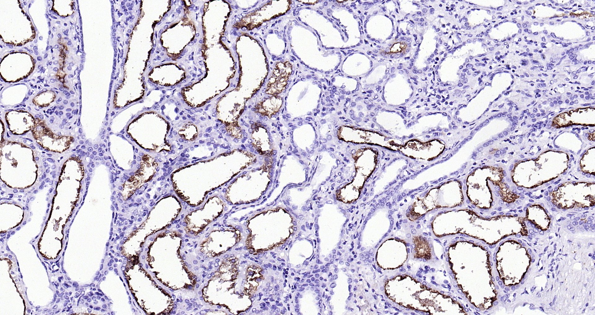 Paraformaldehyde-fixed, paraffin embedded (Human kidney cancer); Antigen retrieval by boiling in sodium citrate buffer (pH6.0) for 15min; Block endogenous peroxidase by 3% hydrogen peroxide for 20 minutes; Blocking buffer (normal goat serum) at 37°C for 30min; Antibody incubation with (ACE2) Polyclonal Antibody, Unconjugated (bs-46001R) at 1:200 overnight at 4°C, followed by operating according to SP Kit(Rabbit) (sp-0023 bs-0295G-HRP 1:300) instructionsand DAB staining.