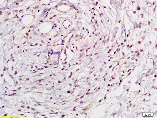 Formalin-fixed and paraffin embedded human gastric tissue labeled with Rabbit Anti-NFkB p105 \/ p50 Polyclonal Antibody, Unconjugated (bs-1194R) at 1:200 followed by conjugation to the secondary antibody and DAB staining\\n