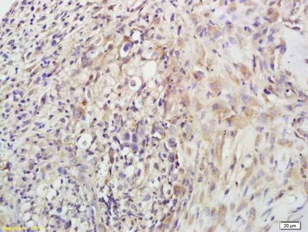 Formalin-fixed and paraffin embedded mouse tumor labeled with Anti-β-endorphin Polyclonal Antibody, Unconjugated (bs-1195R) followed by conjugation to the secondary antibody and DAB staining