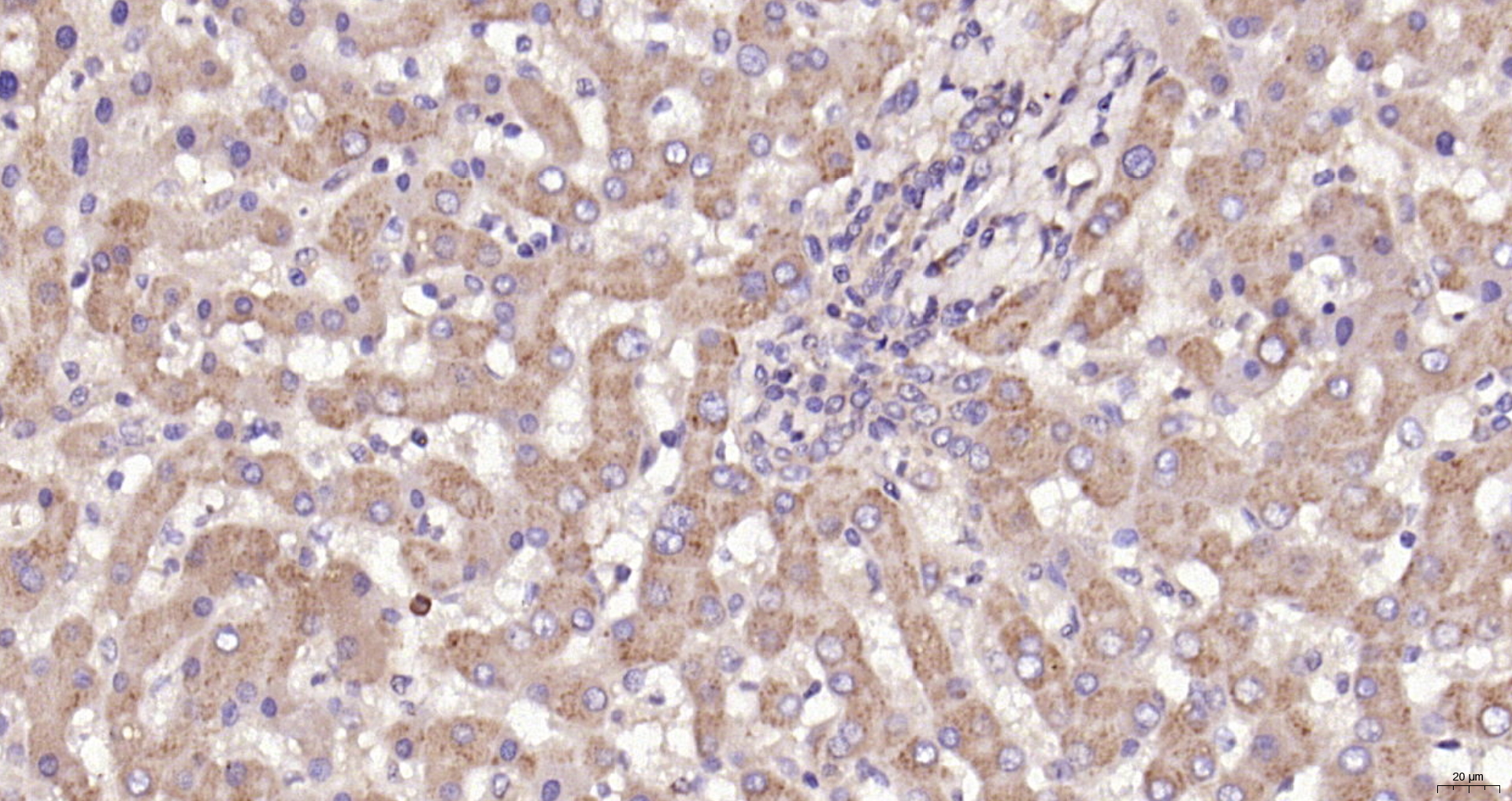 Paraformaldehyde-fixed, paraffin embedded (Human liver ); Antigen retrieval by boiling in sodium citrate buffer (pH6.0) for 15min; Block endogenous peroxidase by 3% hydrogen peroxide for 20 minutes; Blocking buffer (normal goat serum) at 37°C for 30min; Antibody incubation with (Ceramide glucosyltransferase) Polyclonal Antibody, Unconjugated (bs-0701R) at 1:200 overnight at 4°C, followed by operating according to SP Kit(Rabbit) (sp-0023) instructionsand DAB staining.