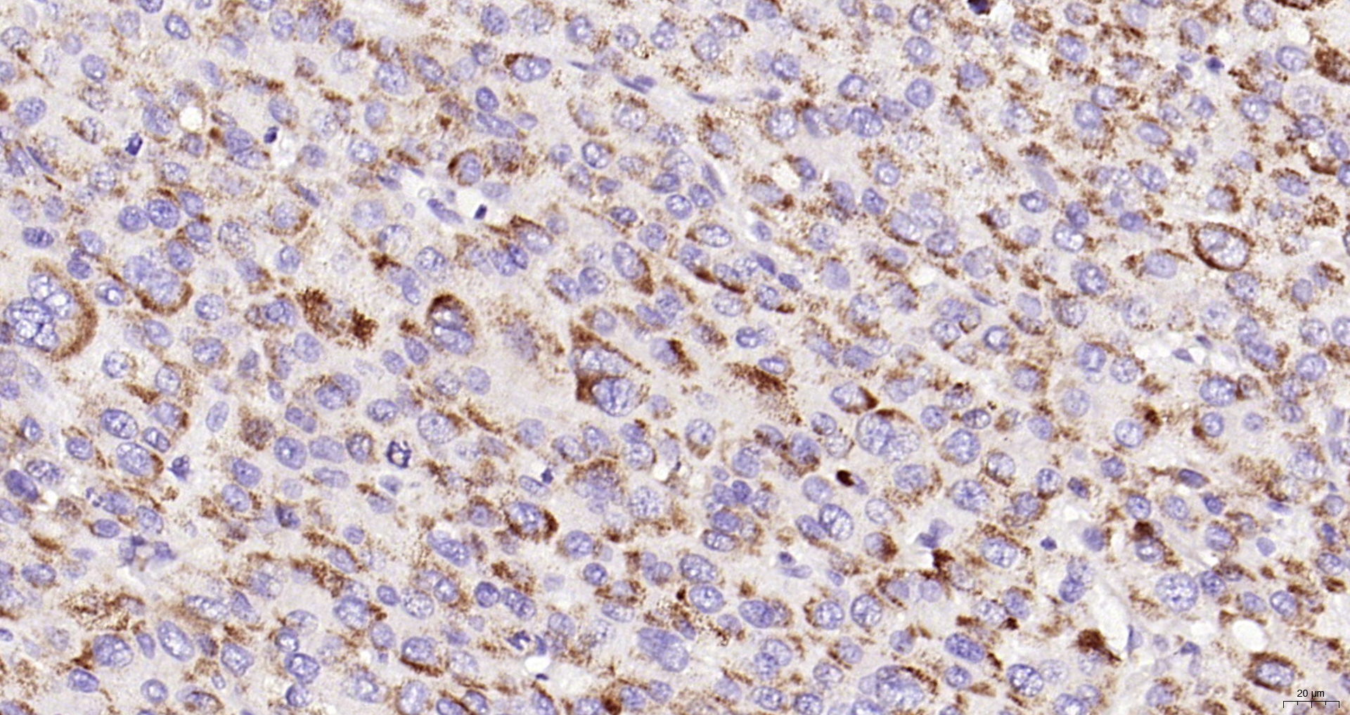 Paraformaldehyde-fixed, paraffin embedded (human liver carcinoma); Antigen retrieval by boiling in sodium citrate buffer (pH6.0) for 15min; Block endogenous peroxidase by 3% hydrogen peroxide for 20 minutes; Blocking buffer (normal goat serum) at 37°C for 30min; Antibody incubation with (phospho-PIK3C3 (Ser282)) Polyclonal Antibody, Unconjugated (bs-5579R) at 1:200 overnight at 4°C, followed by operating according to SP Kit(Rabbit) (sp-0023) instructionsand DAB staining.