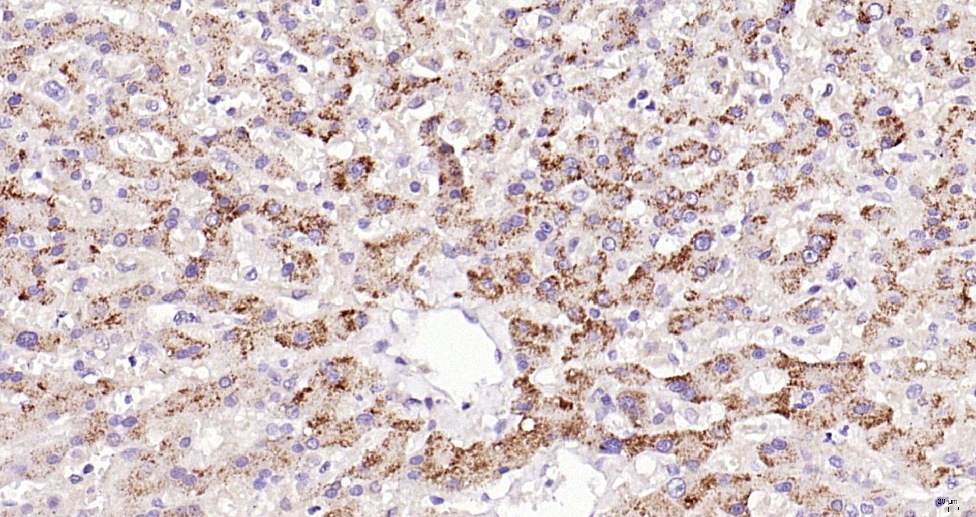 Paraformaldehyde-fixed, paraffin embedded (human liver ); Antigen retrieval by boiling in sodium citrate buffer (pH6.0) for 15min; Block endogenous peroxidase by 3% hydrogen peroxide for 20 minutes; Blocking buffer (normal goat serum) at 37°C for 30min; Antibody incubation with (phospho-PIK3C3 (Ser282)) Polyclonal Antibody, Unconjugated (bs-5579R) at 1:200 overnight at 4°C, followed by operating according to SP Kit(Rabbit) (sp-0023) instructionsand DAB staining.