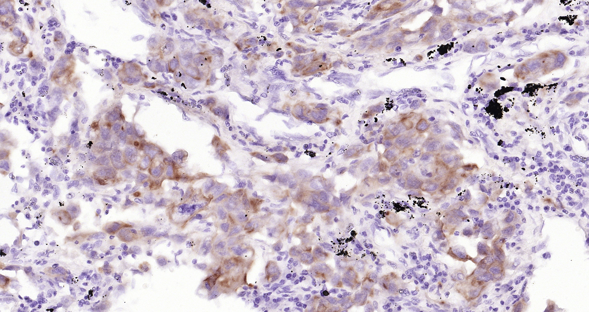 Paraformaldehyde-fixed, paraffin embedded (human lung carcinoma); Antigen retrieval by boiling in sodium citrate buffer (pH6.0) for 15min; Block endogenous peroxidase by 3% hydrogen peroxide for 20 minutes; Blocking buffer (normal goat serum) at 37°C for 30min; Antibody incubation with (CK7) Monoclonal Antibody, Unconjugated (bsm-33060M) at 1:200 overnight at 4°C, followed by operating according to SP Kit(Mouse)(sp-0024 bs-0296G-Bio 1:500) instructionsand DAB staining.