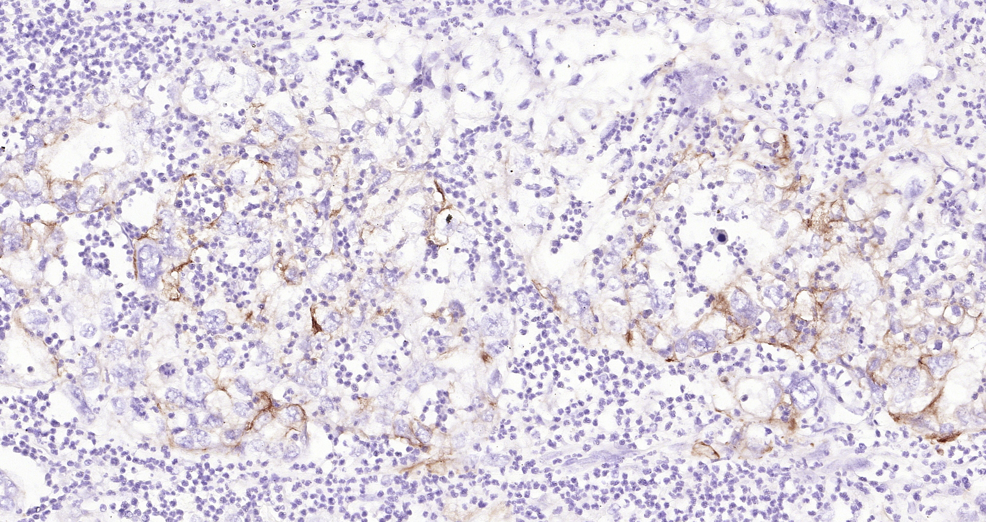 Paraformaldehyde-fixed, paraffin embedded (human endometrial carcinoma); Antigen retrieval by boiling in sodium citrate buffer (pH6.0) for 15min; Block endogenous peroxidase by 3% hydrogen peroxide for 20 minutes; Blocking buffer (normal goat serum) at 37°C for 30min; Antibody incubation with (CK7) Monoclonal Antibody, Unconjugated (bsm-33060M) at 1:200 overnight at 4°C, followed by operating according to SP Kit(Mouse)(sp-0024 bs-0296G-Bio 1:500) instructionsand DAB staining.