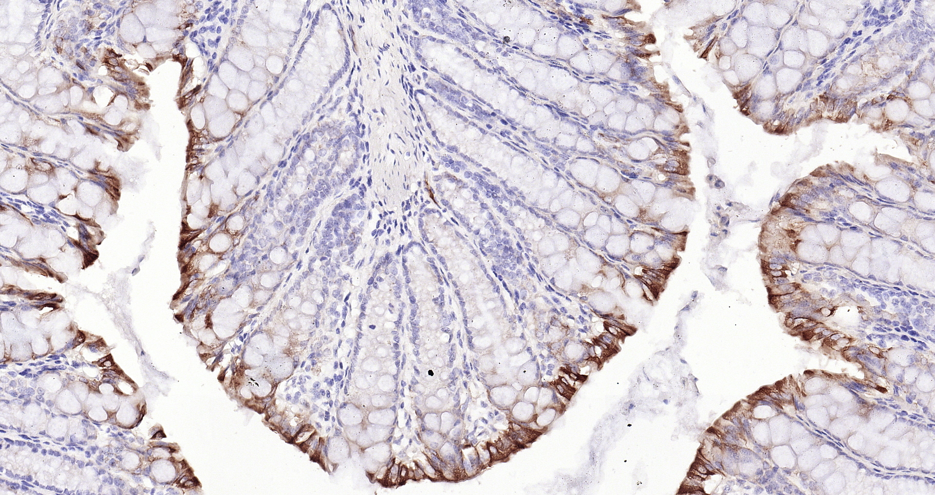Paraformaldehyde-fixed, paraffin embedded (mouse colon); Antigen retrieval by boiling in sodium citrate buffer (pH6.0) for 15min; Block endogenous peroxidase by 3% hydrogen peroxide for 20 minutes; Blocking buffer (normal goat serum) at 37°C for 30min; Antibody incubation with (Cytokeratin 8) Monoclonal Antibody, Unconjugated (bsm-33061M) at 1:200 overnight at 4°C, followed by operating according to SP Kit(Mouse)(sp-0024 bs-0296G-Bio 1:2000) instructionsand DAB staining.