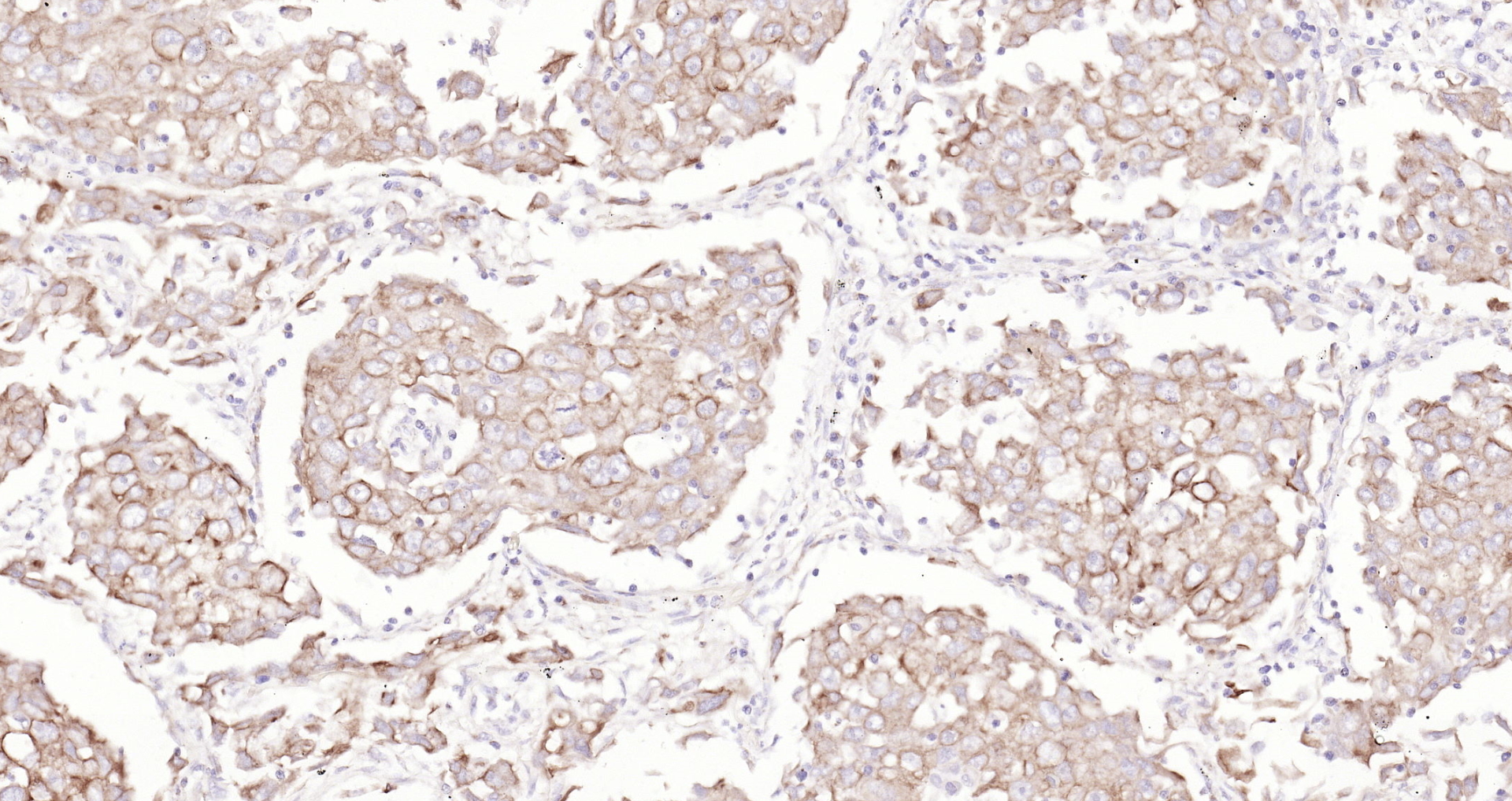 Paraformaldehyde-fixed, paraffin embedded (human lung carcinoma); Antigen retrieval by boiling in sodium citrate buffer (pH6.0) for 15min; Block endogenous peroxidase by 3% hydrogen peroxide for 20 minutes; Blocking buffer (normal goat serum) at 37°C for 30min; Antibody incubation with (Cytokeratin 8) Monoclonal Antibody, Unconjugated (bsm-33061M) at 1:200 overnight at 4°C, followed by operating according to SP Kit(Mouse)(sp-0024 bs-0296G-Bio 1:1000) instructionsand DAB staining.