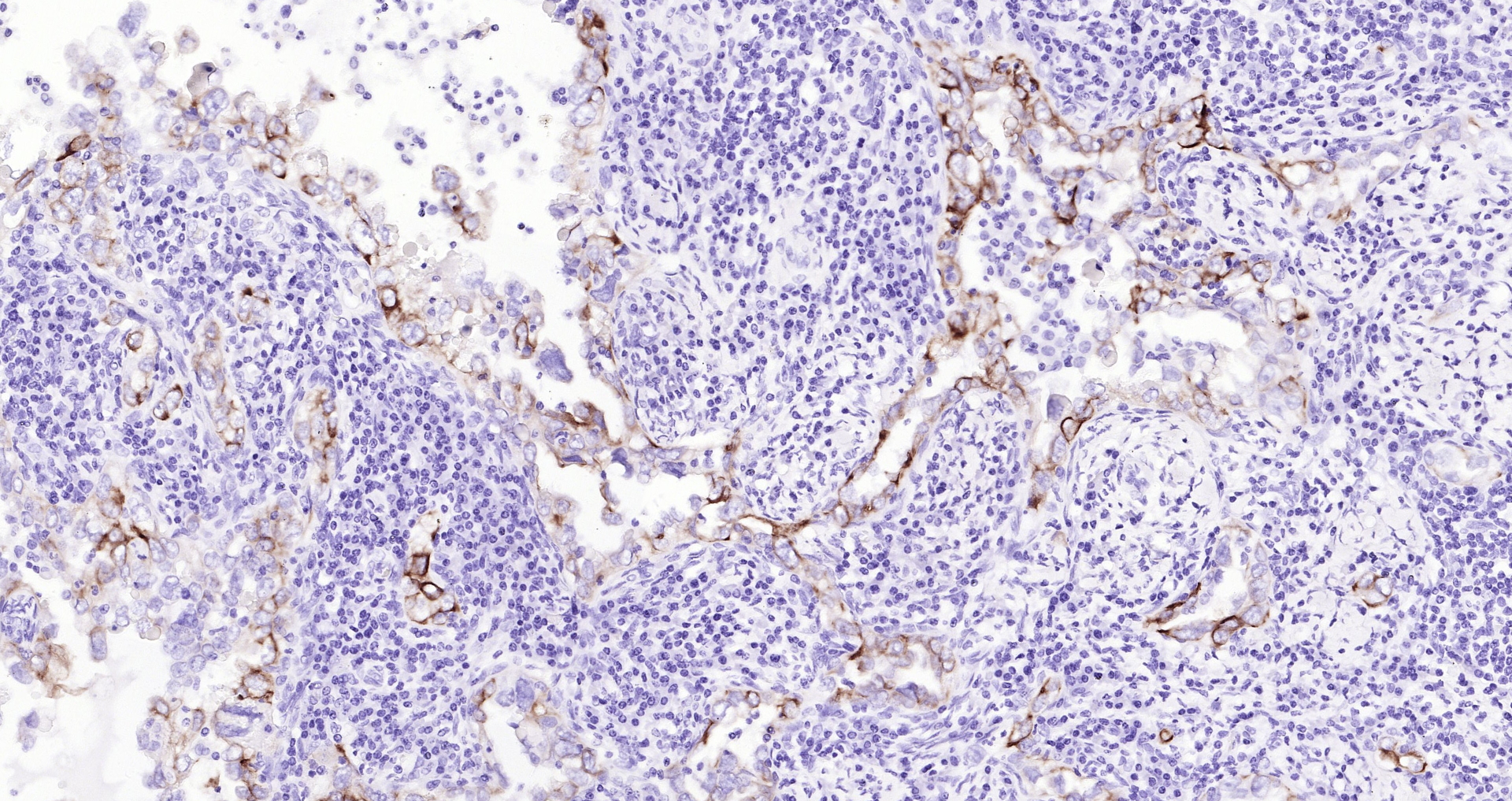 Paraformaldehyde-fixed, paraffin embedded (human cervical carcinoma); Antigen retrieval by boiling in sodium citrate buffer (pH6.0) for 15min; Block endogenous peroxidase by 3% hydrogen peroxide for 20 minutes; Blocking buffer (normal goat serum) at 37°C for 30min; Antibody incubation with (Cytokeratin 8) Monoclonal Antibody, Unconjugated (bsm-33061M) at 1:200 overnight at 4°C, followed by operating according to SP Kit(Mouse)(sp-0024 bs-0296G-Bio 1:500) instructionsand DAB staining.